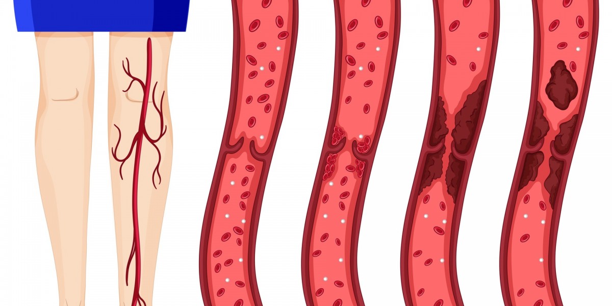 Common DVT Symptoms You Should Never Ignore