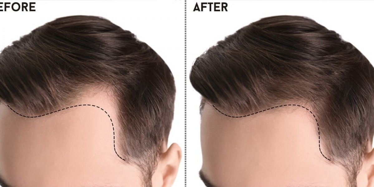 Decoding Excellence: Your Ultimate Guide to Hair Transplant in Islamabad