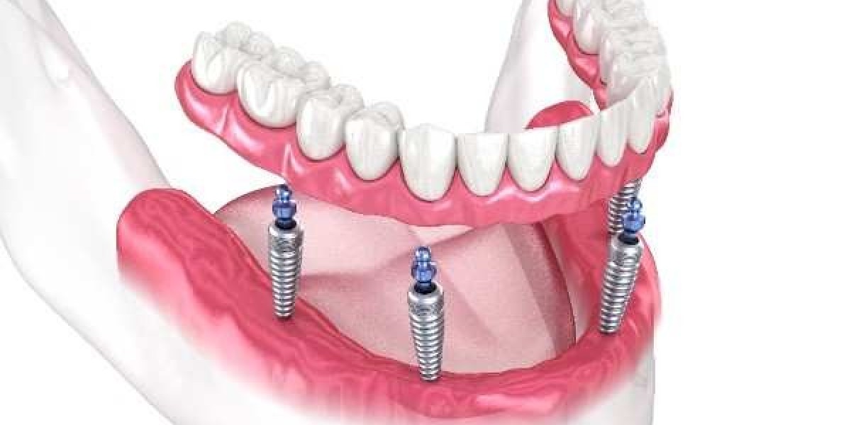 A Complete New Smile with All-on-4 Implants in Maidenhead